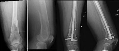 Antegrade femoral RIA bone graft harvesting for subtalar nonunion