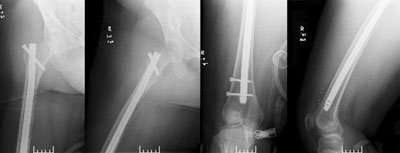 Antegrade femoral RIA bone graft harvesting for right tibiotalocalcaneal fusion