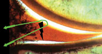 The femoral side vertical mattress suture configuration