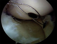 An intra-articular view of two spinal needles