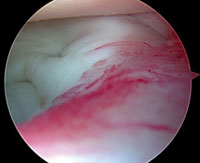 Vascular capillary creep at the conclusion of the meniscal repair