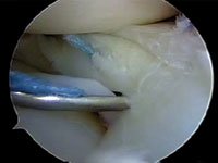 Arthroscopic meniscal repair