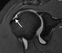 A partial thickness rotator cuff tear