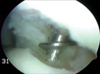 The suture anchor penetrates an intact tendon