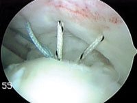 All four sutures after suture passing is completed