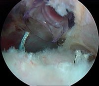 Sutures are tied in the subacromial space