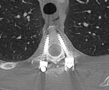 The postoperative angiogram