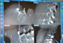 An intraoperative revision of a screw uses navigation