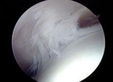 A partial thickness undersurface tear of the posterior aspect of the supraspinatus tendon