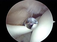 The surgeon uses a shaver to debride a partial thickness rotator cuff tear