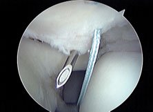 A spinal needle is placed through both laminations of the tear