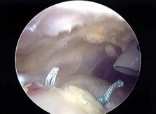 The sutures are tied in the subacromial space