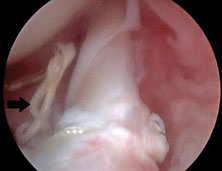 Arthroscopic image in a 26-year-old man who had previous SLAP 2 repair