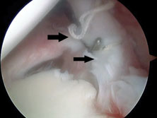 Arthroscopic image of a 32-year-old man who had previous SLAP 2 repair