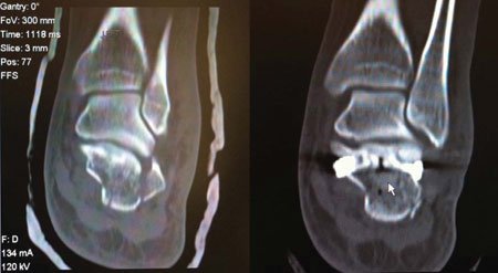 Preoperative and Postoperative CT