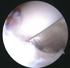 Elevation of posterior facet