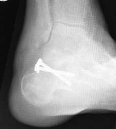 Follow-up radiograph