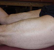 The appearance of chronic proximal hamstring rupture