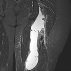 Complete proximal hamstring rupture with large hematoma and tendon retraction