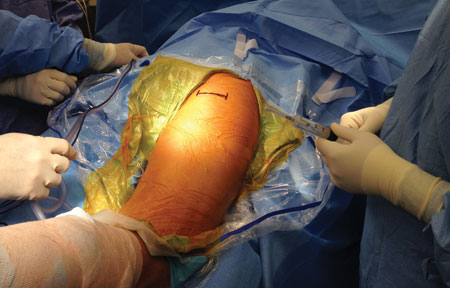 The location of the transverse skin incision in the gluteal fold