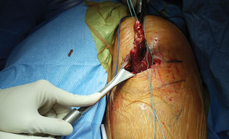 The proximal hamstring tendon end is identified, mobilized  and prepared for suturing