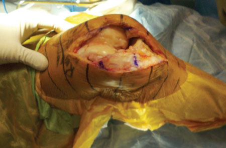 Patellar retraction