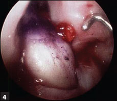 Intraoperative arthroscopic image during the revision ACLR.