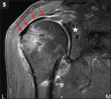 MRI shows intact graft