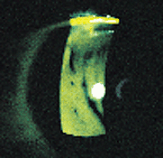 fluorescein imaging