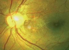 Proliferative diabetic retinopathy [photo]