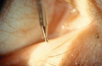 Punctal dilation [photo]