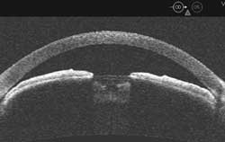 Image from Visante Anterior Chamber OCT shows example of a narrow angle