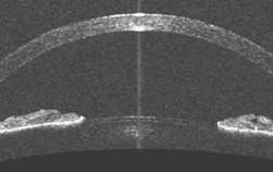 Image from the Heidelberg Anterior Chamber OCT shows example of an open angle