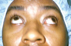 Adult with exotropia