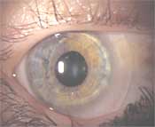 Slit lamp photo shows eye with contact lens in place