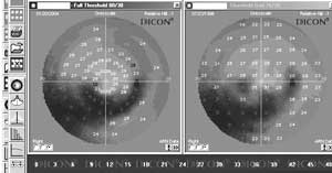 Visual fields done with the Dicon 400