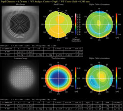 Emerging keratoconus: map of uncorrected eye