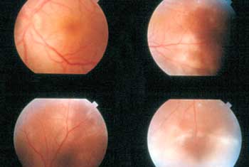 Ocular syphyilis images