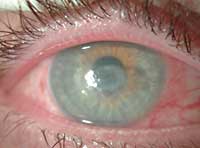 Acanthamoeba keratitis