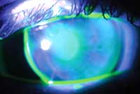 Initial gas-permeable lenses post eight-incision RK