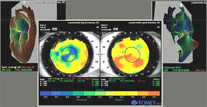 Post-RK corneal topography