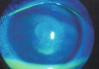 Fluorescein staining in a dry eye patient