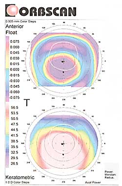 Orbscan “anterior float” and “keratometric” analysis of the dramatic keratoconus of the right eye of this patient