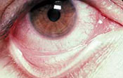 Seasonal allergic conjunctivitis