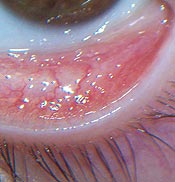 This dense follicular conjunctivitis was seen in a young Lyme disease patient