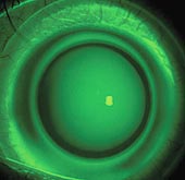 Apical clearance options