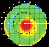 Decentered multifocal: This over-topography shows a slightly decentered near segment