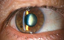 This image shows a milky sclerotic cataract with PSC