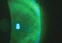 A dendriform lesion appears in the peripheral cornea of an AK patient