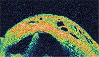 An OCT is used to evaluate the anatomy of a filtering bleb